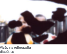 Visão na retinopatia diabética Visão na retinopatia diabética