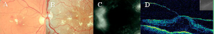 cirurgia para o Glaucoma