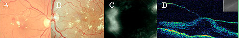 cirurgia para o Glaucoma cirurgia para o Glaucoma