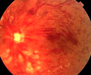 cirurgia para o Glaucoma cirurgia para o Glaucoma