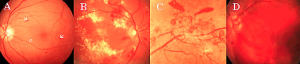 cirurgia para o Glaucoma