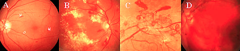 cirurgia para o Glaucoma cirurgia para o Glaucoma