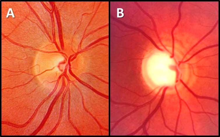 Glaucoma